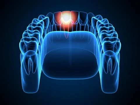 3d render of  jaw x-ray with aching tooth Stock Illustration