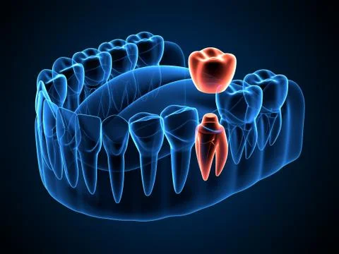 3d render of jaw x-ray  with dental crown embed on tooth Stock Illustration