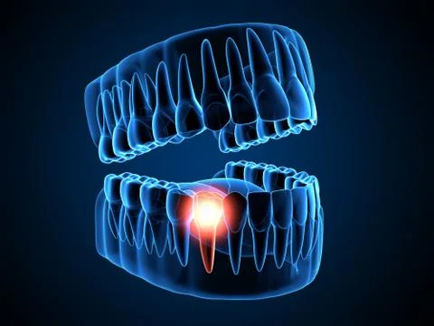 3d render of  jaw x-ray with aching tooth Illustrazione stock