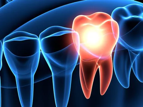 3d render of  jaw x-ray with aching tooth Illustrazione stock