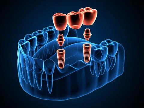 3d render of jaw x-ray with implants supported dental bridge Stock Illustration