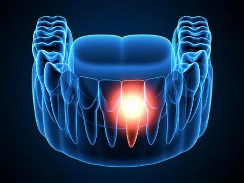 3d render of  jaw x-ray with aching tooth Stock Illustration