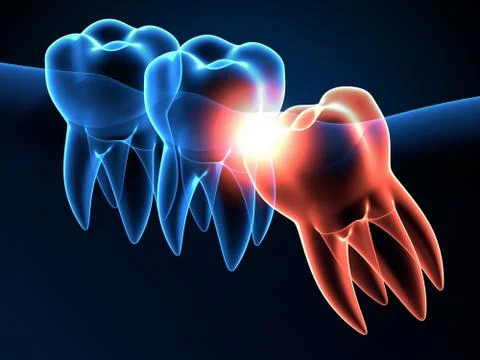 3d render of jaw x-ray with wisdom mesial impaction Illustrazione stock