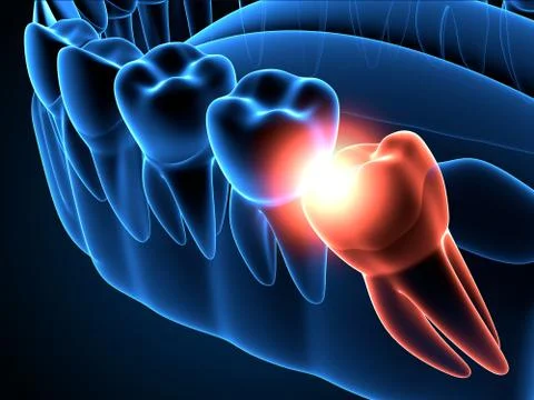3d render of jaw x-ray with wisdom mesial impaction Stock Illustration