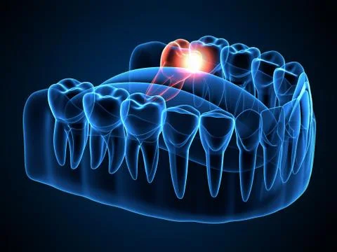 3d render of jaw x-ray with wisdom mesial impaction Stock Illustration