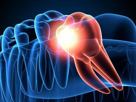 3d render of jaw x-ray with wisdom mesial impaction Stock Illustration