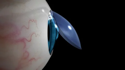 3d render laser eye surgery by Polymime http://www.polymime.com Stock Footage 75407392