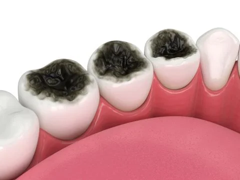 3d render of lower jaw and teeth with caries Stock Illustration