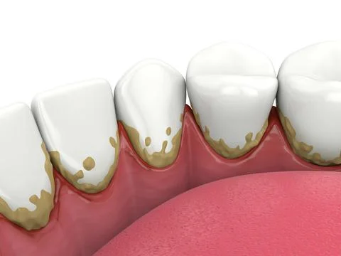 3d render of lower jaw with calculus buildup on teeth line and making inflamm 스톡 일러스트