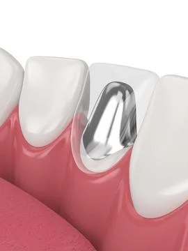 3d render of lower jaw with cast post and core tooth restoration Stock Illustration
