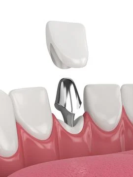 3d render of lower jaw with cast post and core tooth restoration Stock Illustration