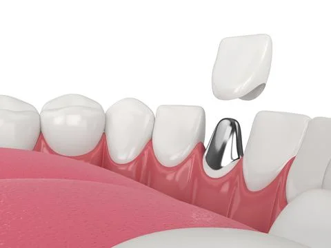 3d render of lower jaw with cast post and core tooth restoration Stock Illustration