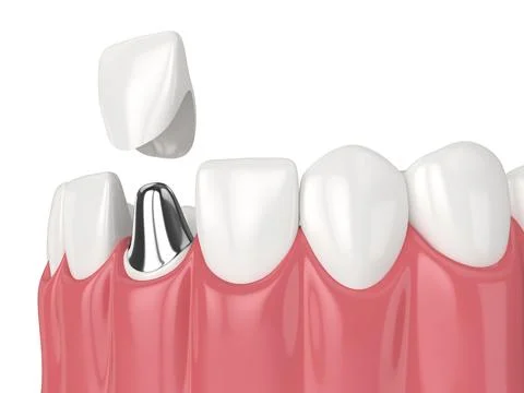 3d render of lower jaw with cast post and core tooth restoration Stock Illustration