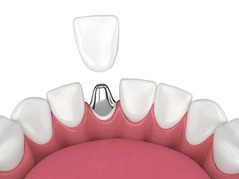 3d render of lower jaw with cast post and core tooth restoration Stock Illustration
