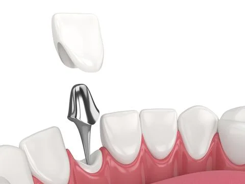 3d render of lower jaw with cast post and core tooth restoration Stock Illustration