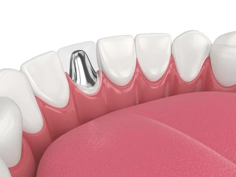 3d render of lower jaw with cast post and core tooth restoration Stock Illustration