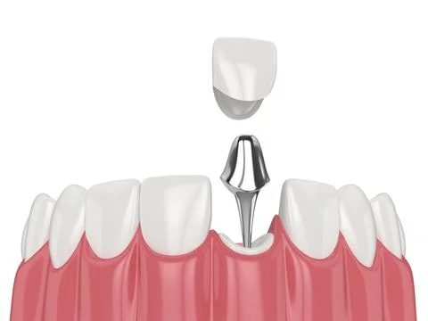 3d render of lower jaw with cast post and core tooth restoration Stock Illustration