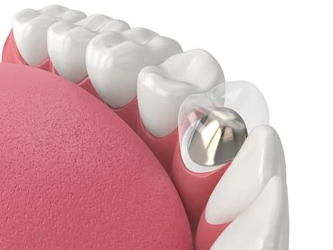3d render of lower jaw with cast post and core tooth restoration Stock Illustration