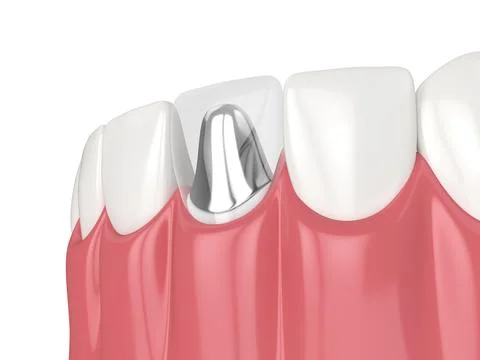 3d render of lower jaw with cast post and core tooth restoration Stock Illustration