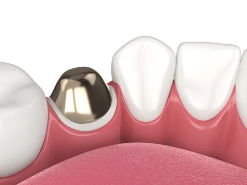 3d render of lower jaw with cast post and core tooth restoration Stock Illustration