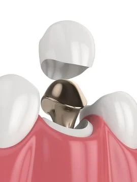 3d render of lower jaw with cast post and core tooth restoration Stock Illustration