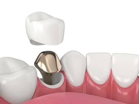 3d render of lower jaw with cast post and core tooth restoration Illustrazione stock