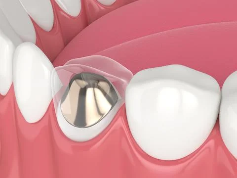 3d render of lower jaw with cast post and core tooth restoration Stock Illustration