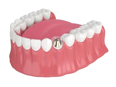 3d render of lower jaw with cast post and core tooth restoration Stock Illustration