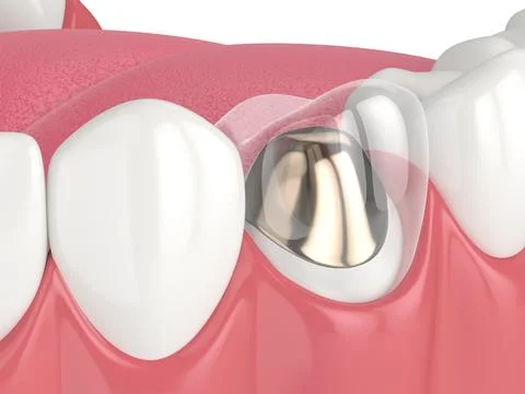 3d render of lower jaw with cast post and core tooth restoration Stock Illustration
