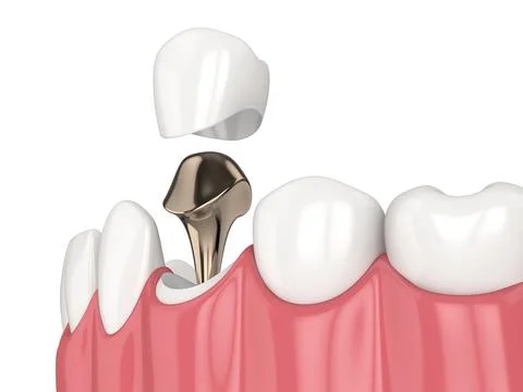 3d render of lower jaw with cast post and core tooth restoration Stock Illustration