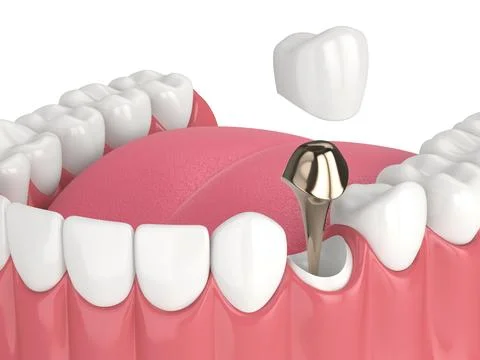 3d render of lower jaw with cast post and core tooth restoration Stock Illustration
