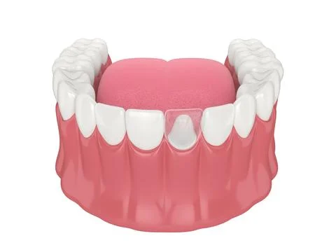 3d render of lower jaw with dental post and core tooth restoration Stock Illustration