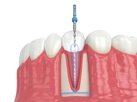 3d render of lower jaw with endodontic rotary file over white background Stock Illustration