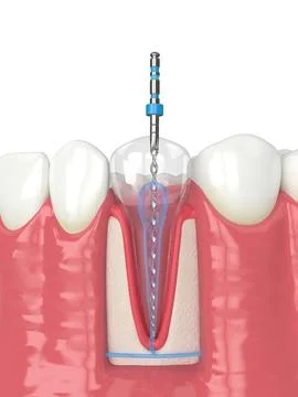 3d render of lower jaw with endodontic rotary file over white background Illustrazione stock