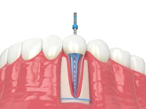 3d render of lower jaw with endodontic rotary file over white background Stock Illustration