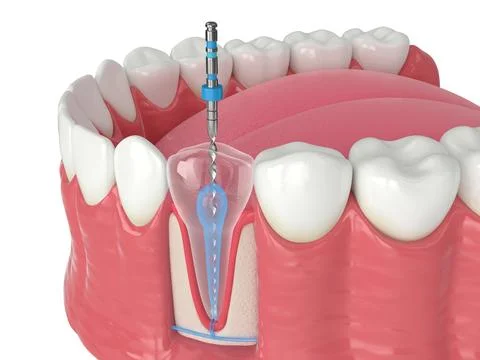 3d render of lower jaw with endodontic rotary file over white background Stock Illustration