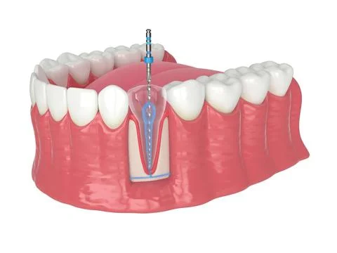 3d render of lower jaw with endodontic rotary file over white background Stock Illustration