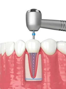 3d render of lower jaw with handpiece and endodontic rotary file over white.. Stock Illustration