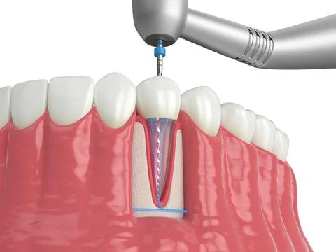 3d render of lower jaw with handpiece and endodontic rotary file over white.. Stock Illustration