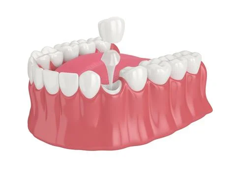 3d render of lower jaw with post and core tooth restoration Stock Illustration