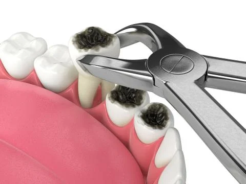 3d render of lower jaw with tooth extracted by dental forceps Stock Illustration