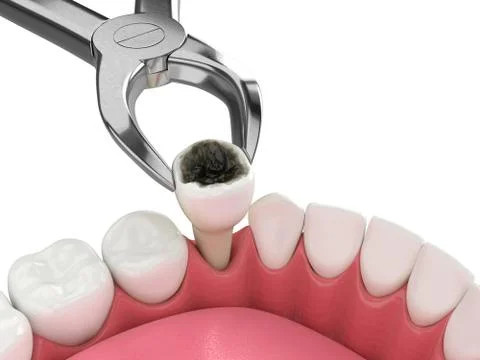 3d render of lower jaw with tooth extraction Illustrazione stock