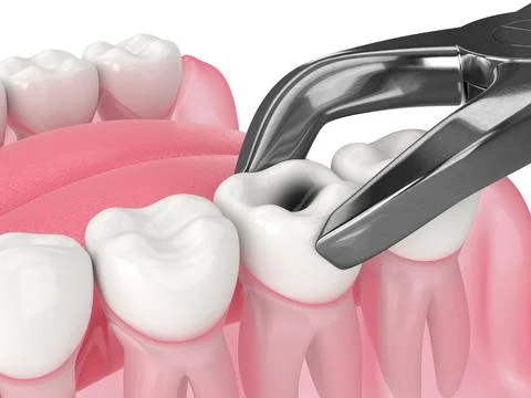 3d render of lower jaw with tooth extraction Stock Illustration