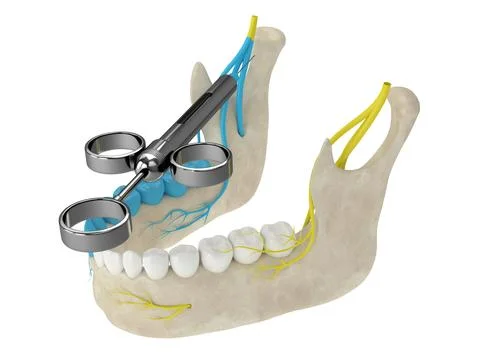 3d render of mandibular arch with gow-gates nerve block Illustrazione stock