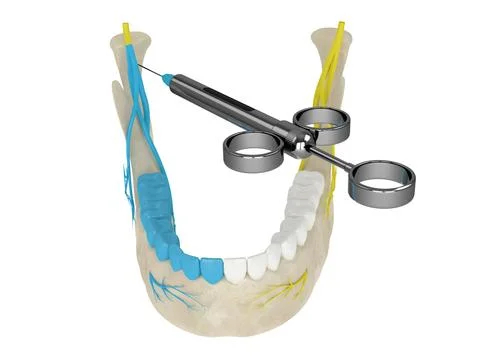 3d render of mandibular arch with gow-gates nerve block Stock Illustration