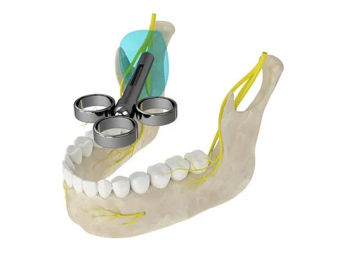 3d render of mandibular arch with gow-gates nerve block Stock Illustration