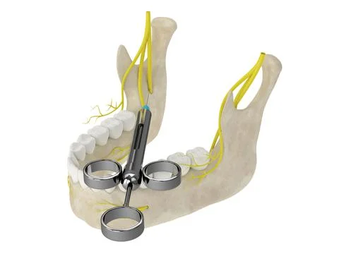 3d render of mandibular arch with inferior alveolar nerve block Stock Illustration