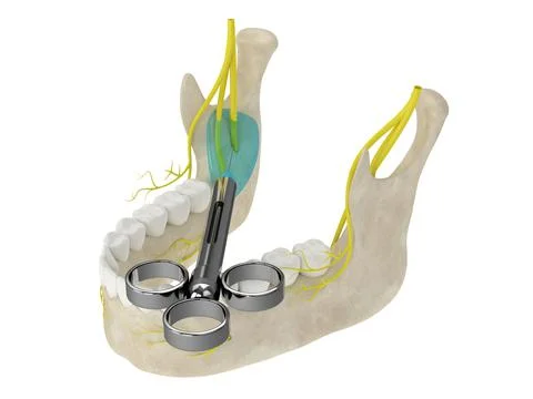 3d render of mandibular arch with inferior alveolar nerve block Illustrazione stock