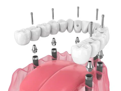 3d render of mandibular prosthesis all-on-6 system supported by implants Illustrazione stock