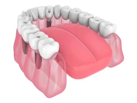3d render of mandibular prosthesis all-on-6 system supported by implants Stock Illustration